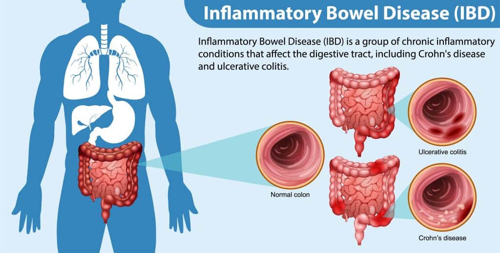 How to Start an Effective IBD Journal